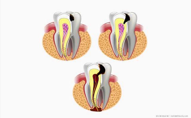 Entzündung und Absterben eines Zahnnervs