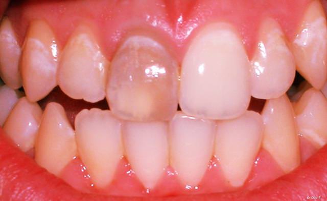 Abgestorbener und dunkel verfärbter Zahn
