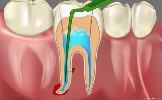 Gründliche Reinigung und Desinfektion des Zahninneren